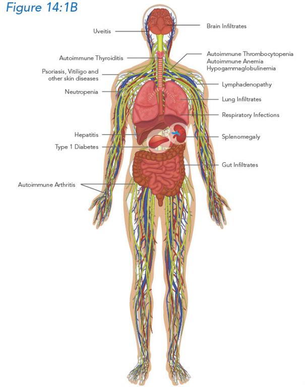 Autoimmune symptoms associated with CTLA-4 haploinsufficiency and LRBA deficiency.